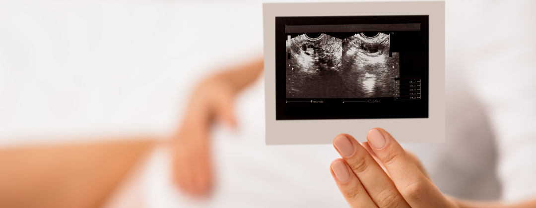 Ovarian Cysts