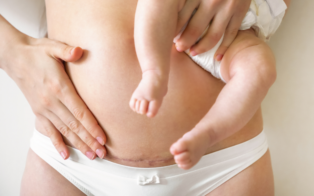 What Is an Isthmocele and How Does It Affect Pregnancy?