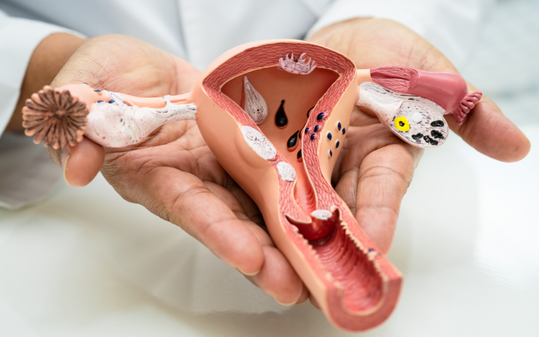 Endometrial Polyps: Causes, Symptoms and Treatment