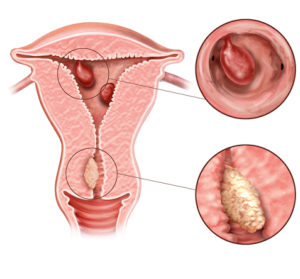 Endometrial polipler