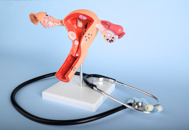 Hysteroscopic Myomectomy: Removal of Fibroids from the Uterus Using a Minimally Invasive Technique